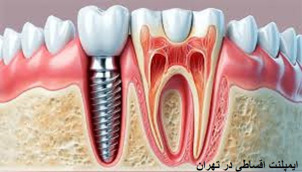 ایمپلنت اقساطی در تهران: راهنمای جامع برای دریافت ایمپلنت با پرداخت اقساطی
