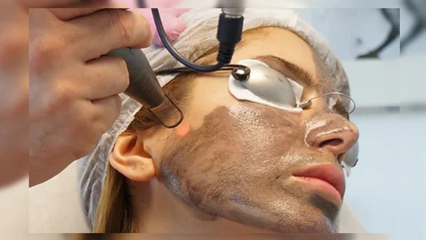 پوست کربن تراپی چیست؟ معجزه ای برای جوانسازی و زیبایی پوست