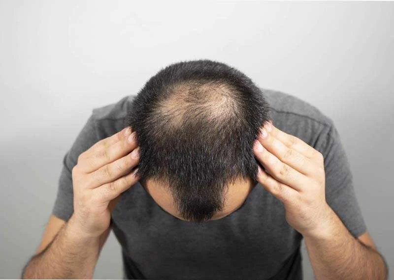  بهترین مکمل غذایی برای جلوگیری از ریزش مو
