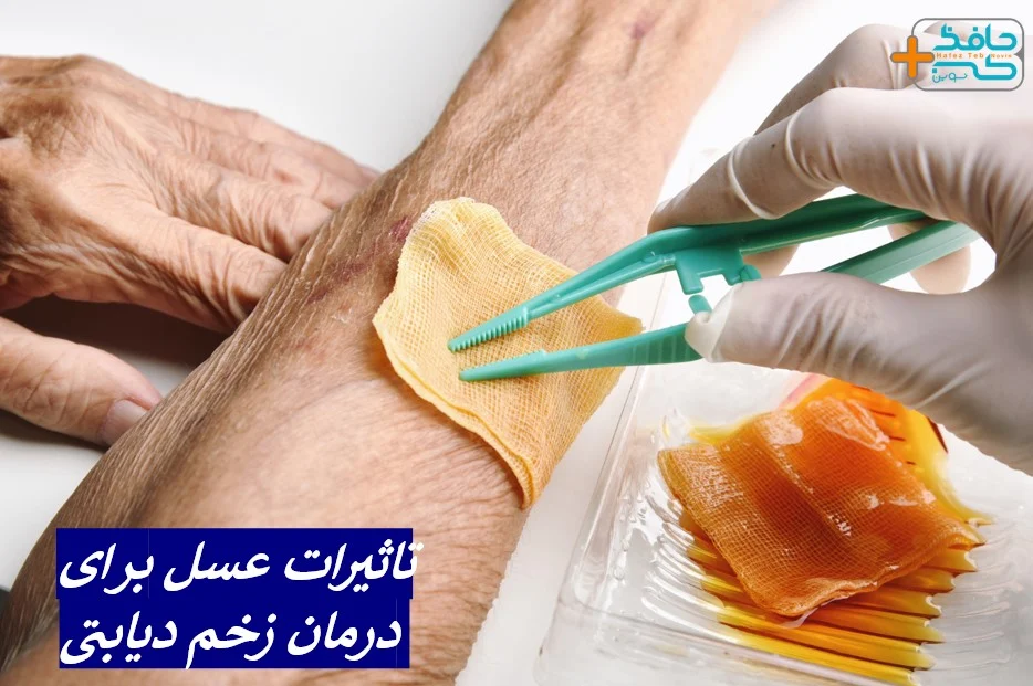 عسل تأثیرات عسل بر درمان زخم دیابتی