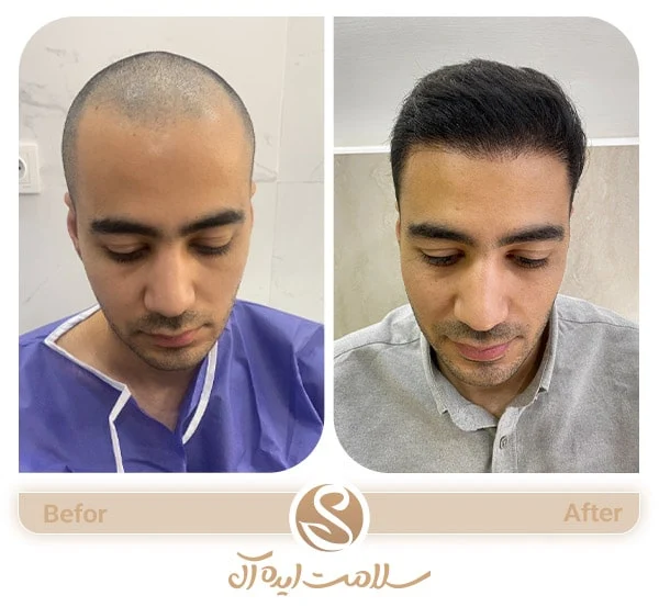 کاشت مو | پوست بهترین سن برای کاشت مو آقایان ( سن مناسب کاشت مو )