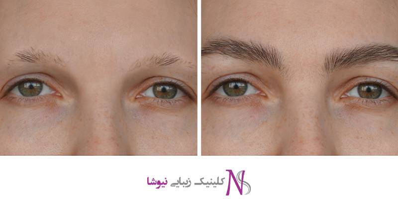 کاشت ابرو روشی نوین، طبیعی و دائمی برای افزایش تراکم موهای ابرو