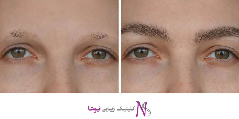 کاشت ابرو روشی نوین، طبیعی و دائمی برای افزایش تراکم موهای ابرو