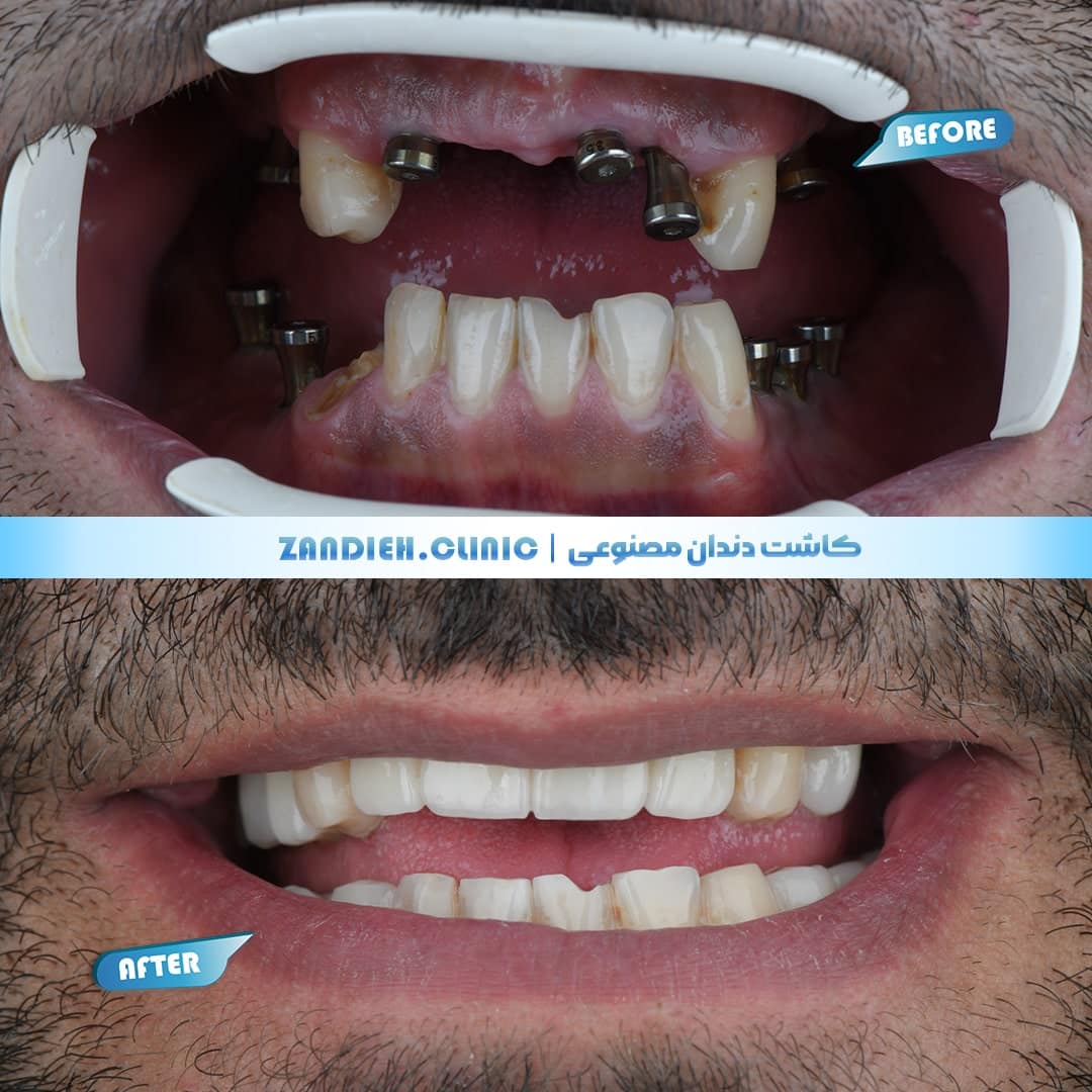 ایمپلنت دندان در بهترین کلینیک دندانپزشکی شیراز