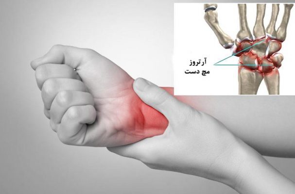 چه کسانی نیاز به تعویض مفصل مچ دست دارند و چه انتظاری باید داشته باشند