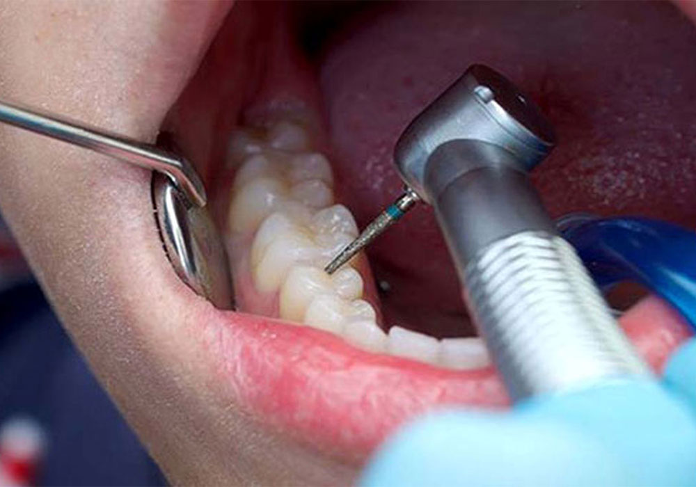 بهترین کلینیک دندان پزشکی برای عصب‌کشی و روکش دندان