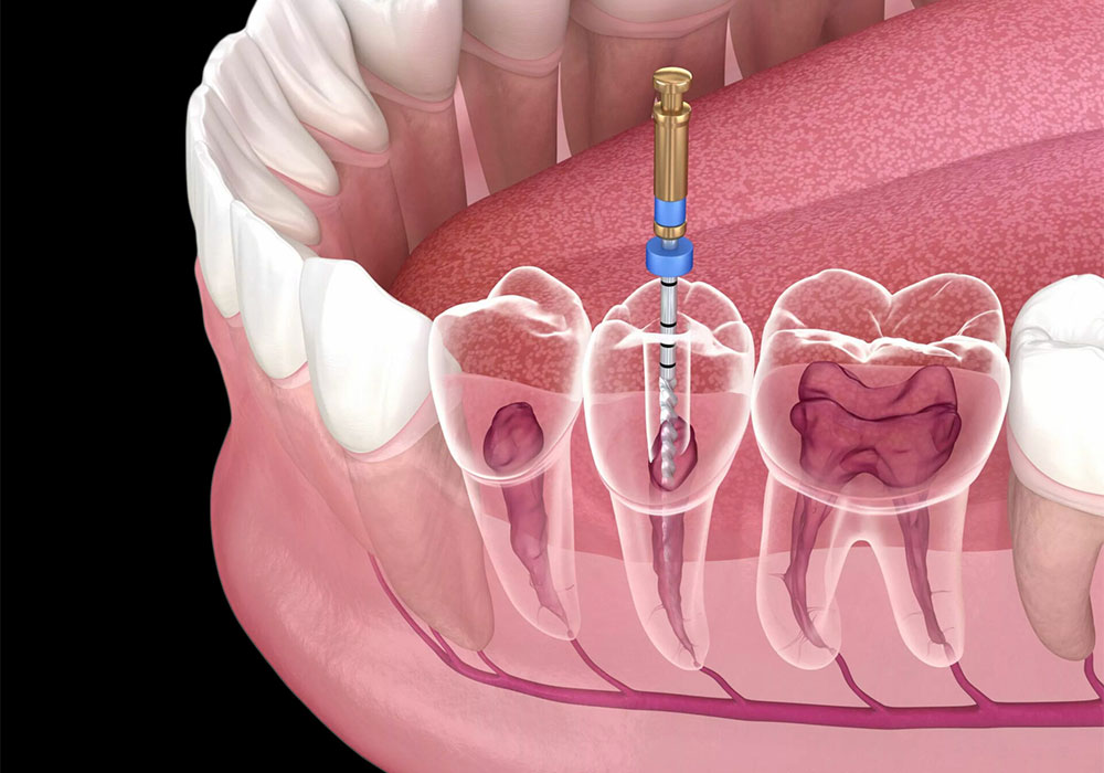 بهترین کلینیک دندان پزشکی برای عصب‌کشی و روکش دندان