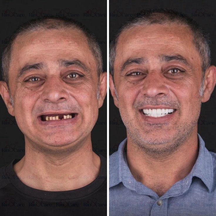 آیا ایمپلنت دندان برای همه مناسب است؟ + مشاوره رایگان