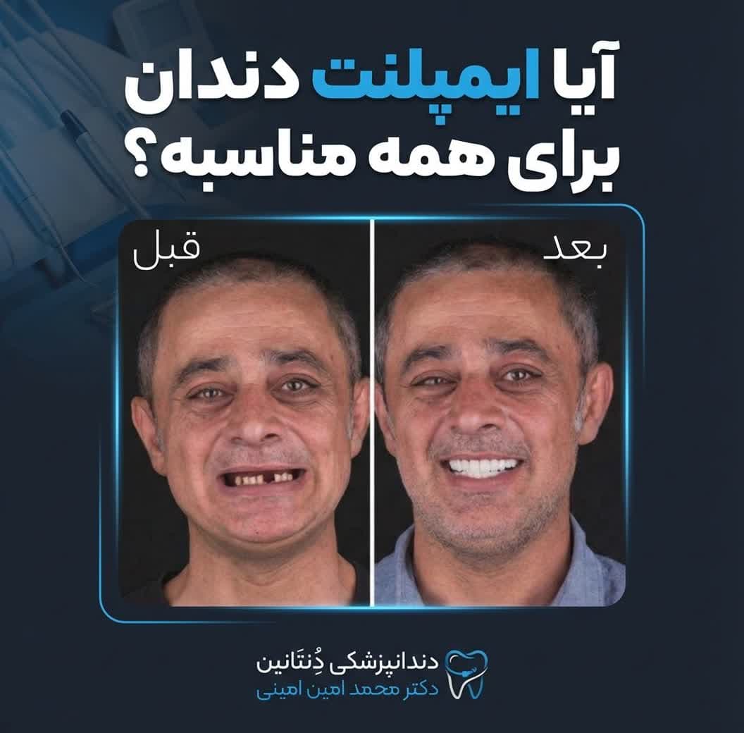 آیا ایمپلنت دندان برای همه مناسب است؟ + مشاوره رایگان