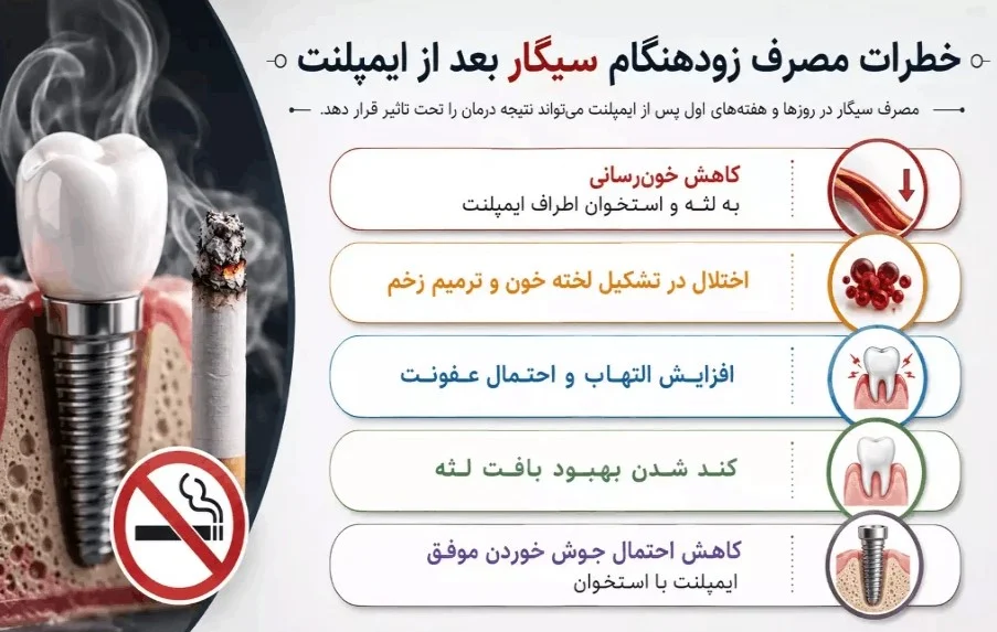 ایمپلنت | جراحی تا چند روز بعد از جراحی ایمپلنت نباید سیگار کشید؟